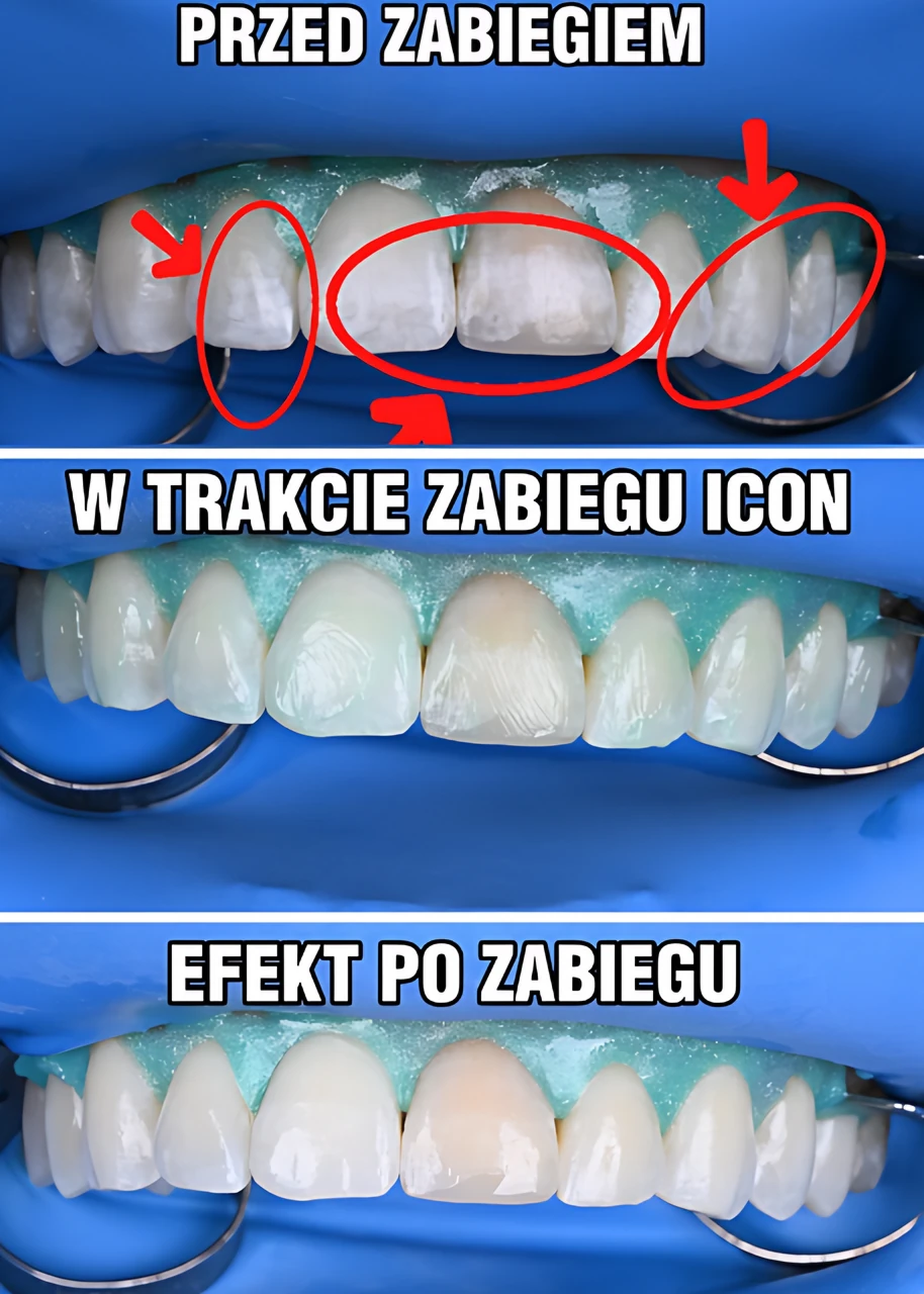 Terapia ICON krok po kroku: białe plamy na zębach przed zabiegiem, w trakcie infiltracji i efekt po zabiegu